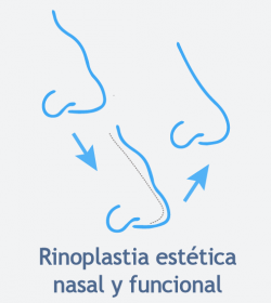 rinoplastia